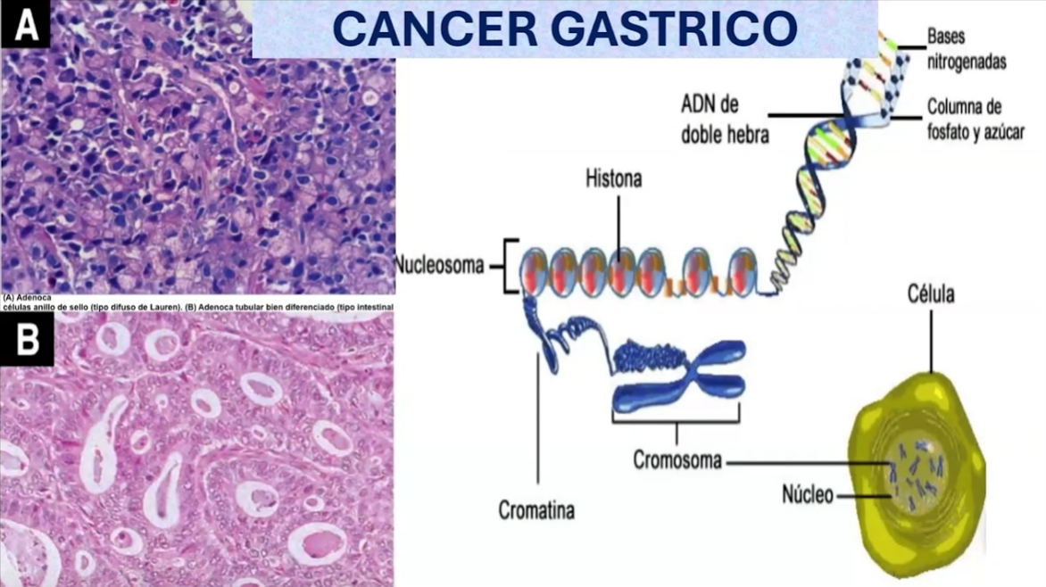 Cáncer Gástrico Manejo Convencional: Quimioterapia-Cirugía Manejo Moderno: Anticuerpos Monoclonales-Inmunoterapia