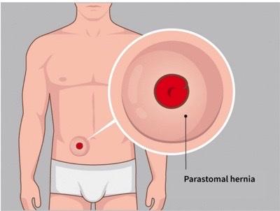 What is a Parastomal Hernia?