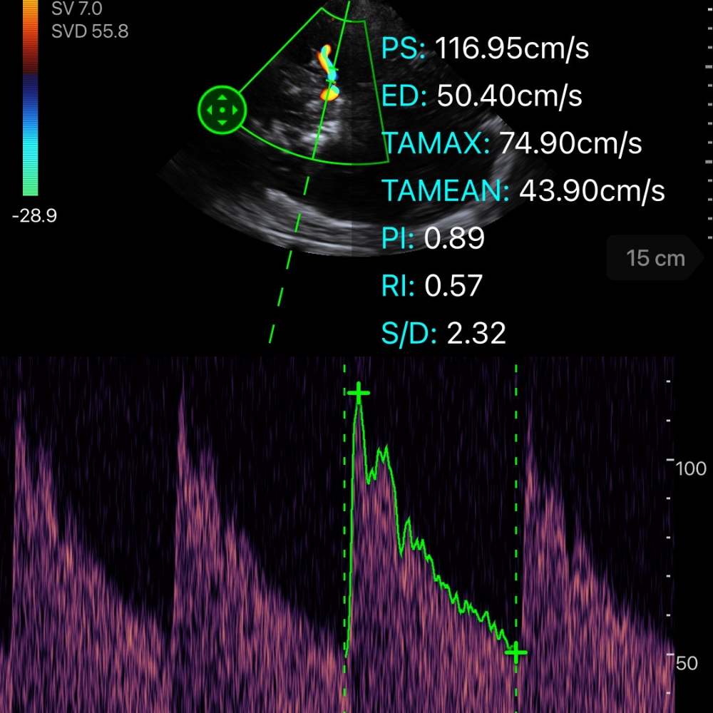 Doppler transcrânien