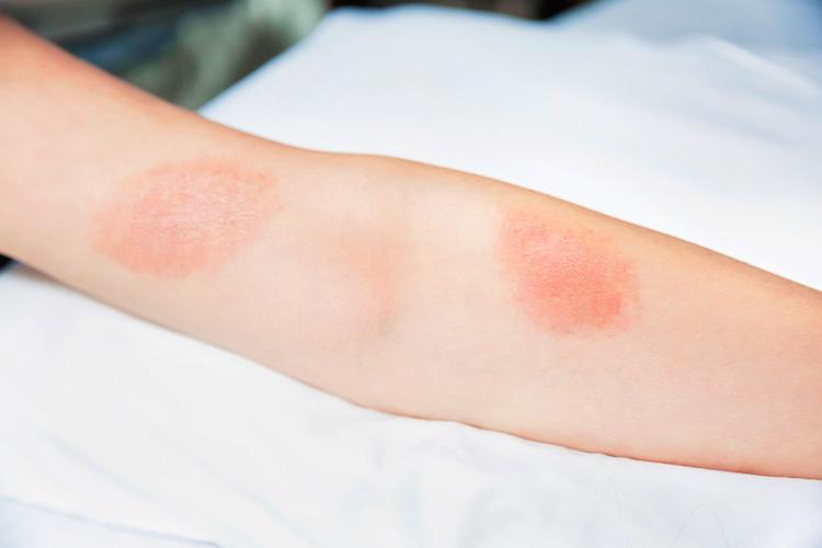 What Does Poison Oak or Poison Ivy Rash Look Like?