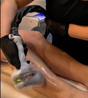 EPILAZIONE LASER
