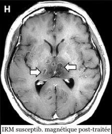 Premier cas de lésions cérébrales dues au COVID-19 à l'IRM
