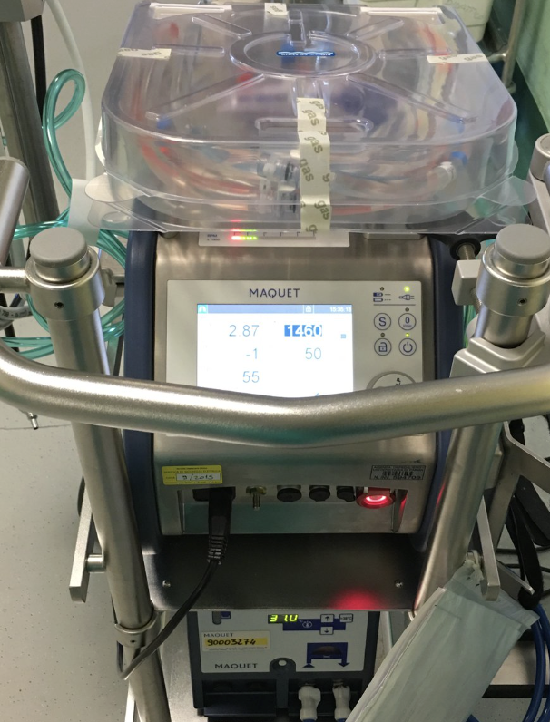 Prélèvements de liquide ECMO pour analyse microbiologique