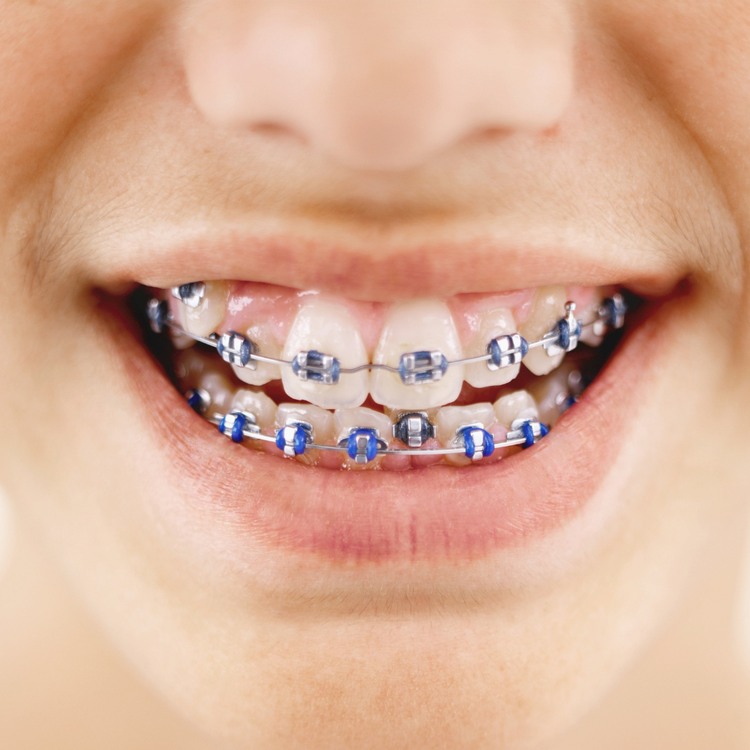 Solutions to Playing with Braces for Brass Players