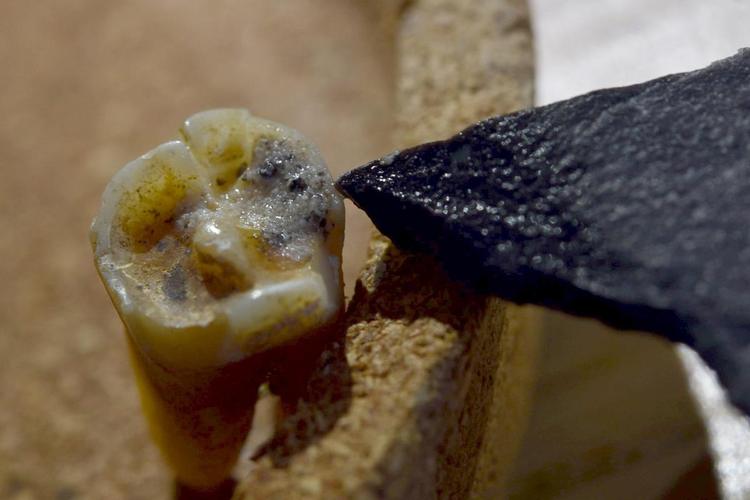 Neanderthal molar from Siberia points to possible dental treatment 59,000 years ago