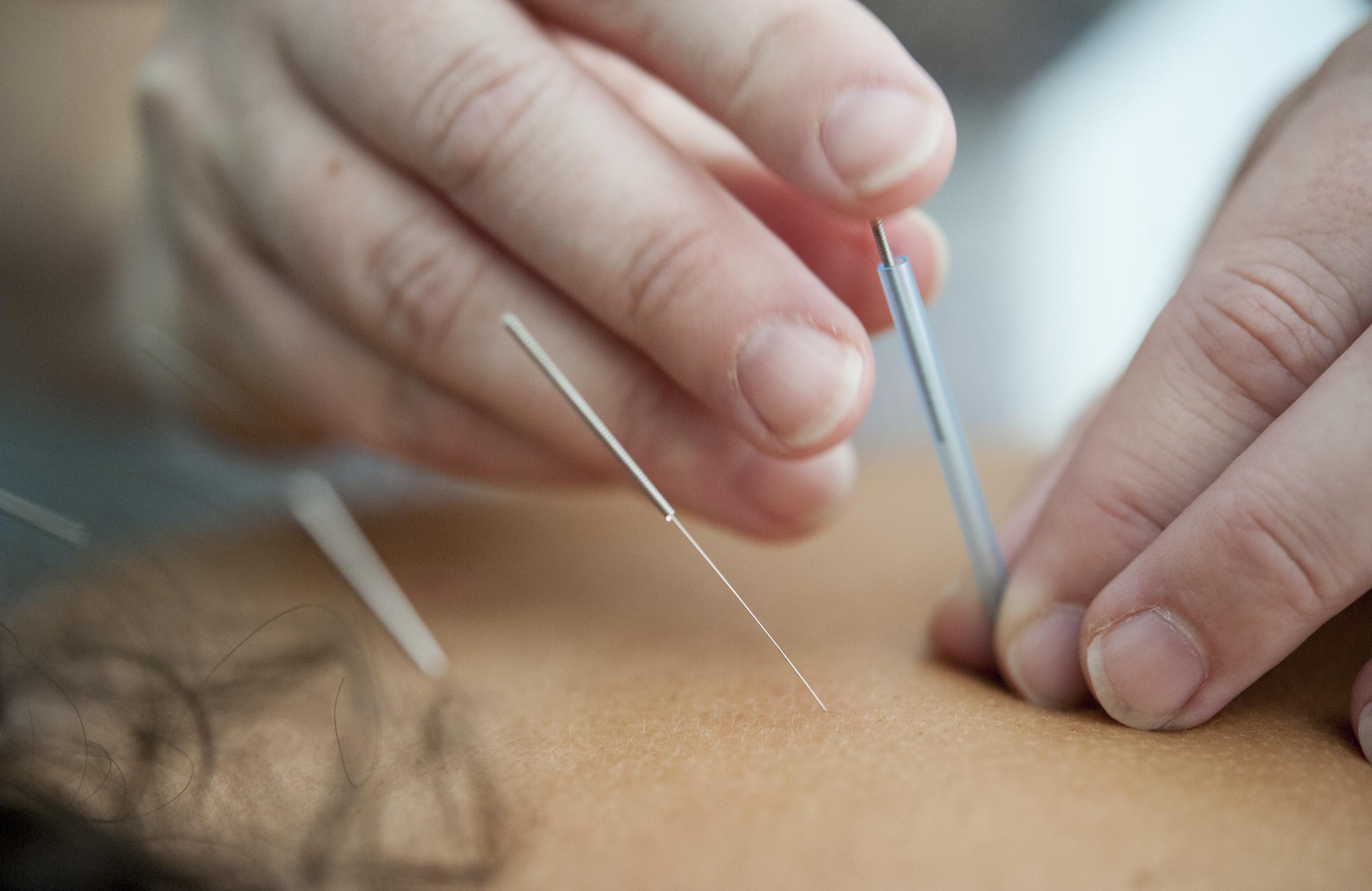 Acupuncture dans les cas des douleurs lombaires chroniques non spécifiques