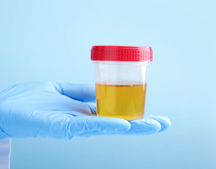 Analisi delle urine