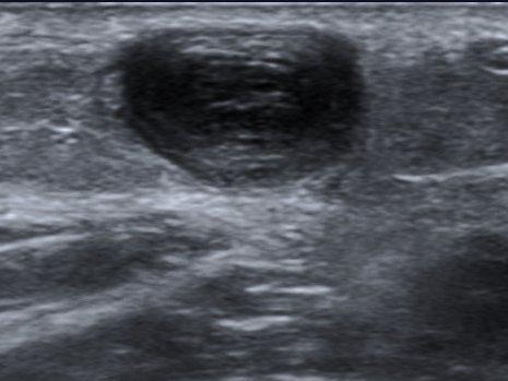 Thrombose veineuse profonde