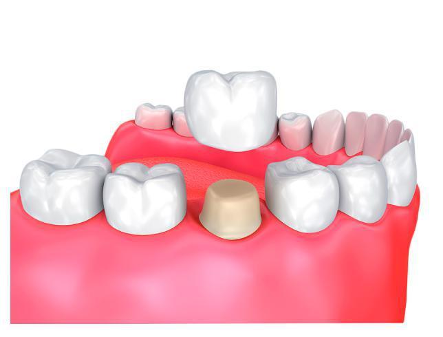 Coronas dentales: