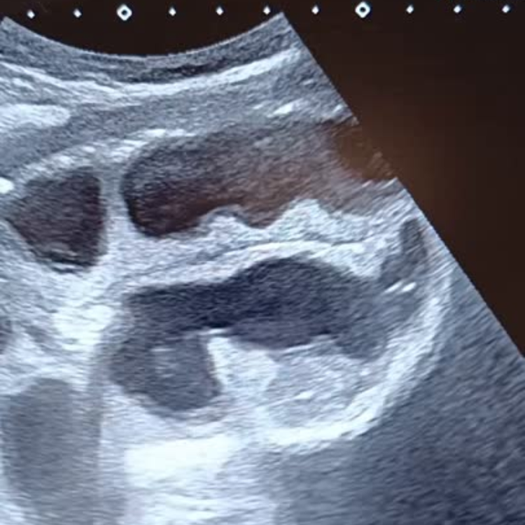 Occlusion Intestinale