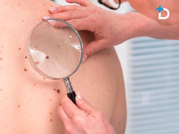 La paradoja de la prevención en Dénia: campañas contra el melanoma, pero sin dermatólogo