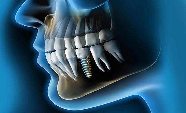 Implantes dentales: