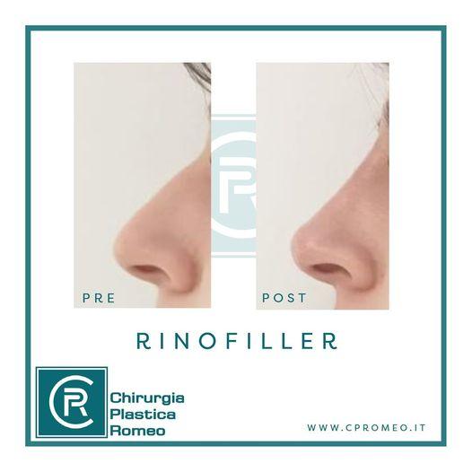 Rinofiller: pre-post