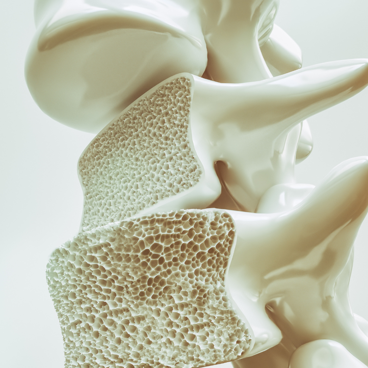 PREVENIAMO L’OSTEOPOROSI