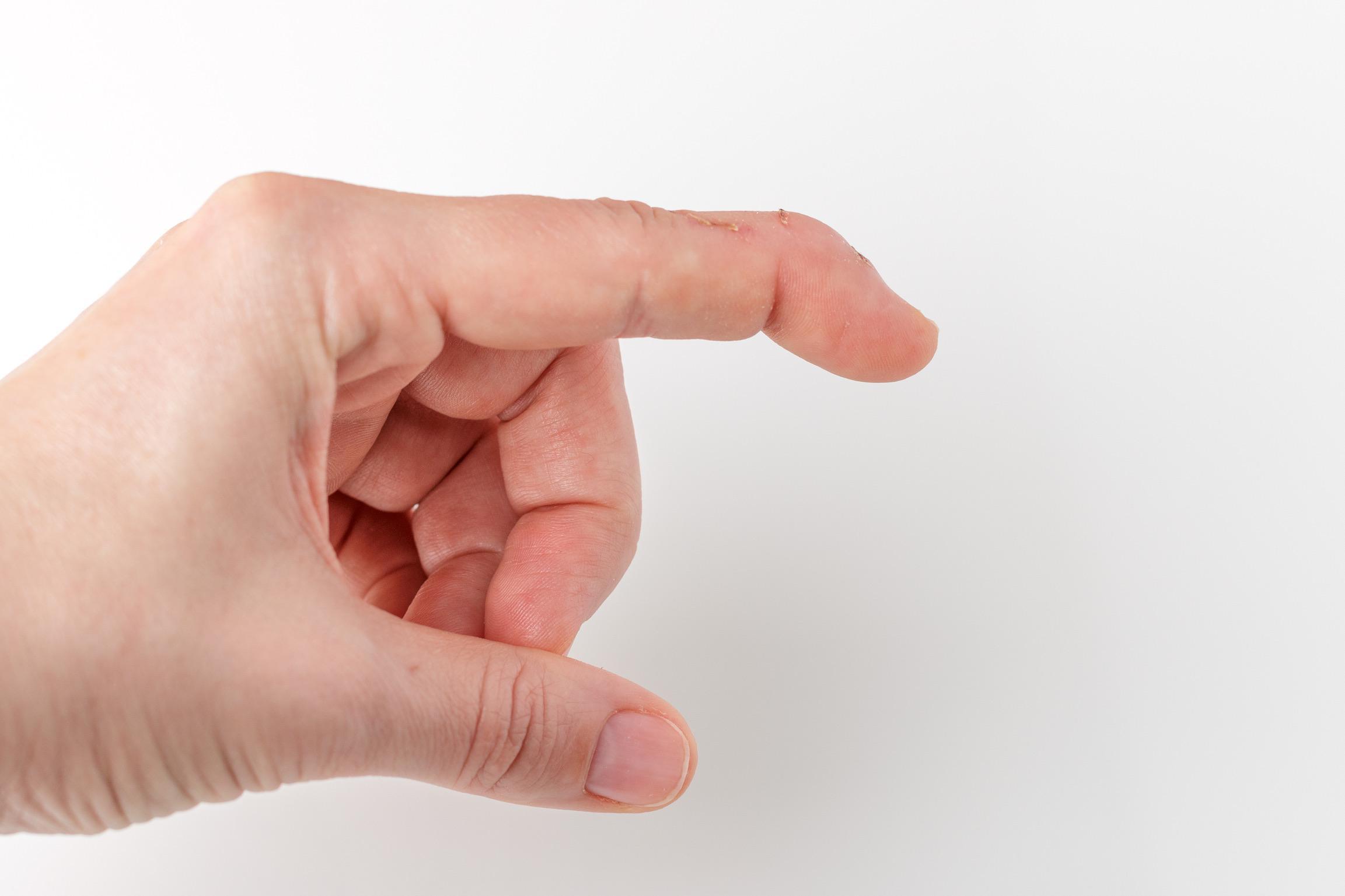 Quand commencer le traitement orthétique d'un maillet tendineux ?