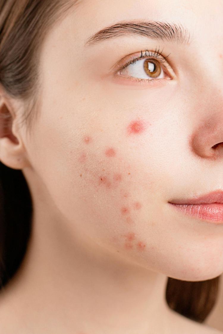 Piel perfecta: consejos para reducir el acné