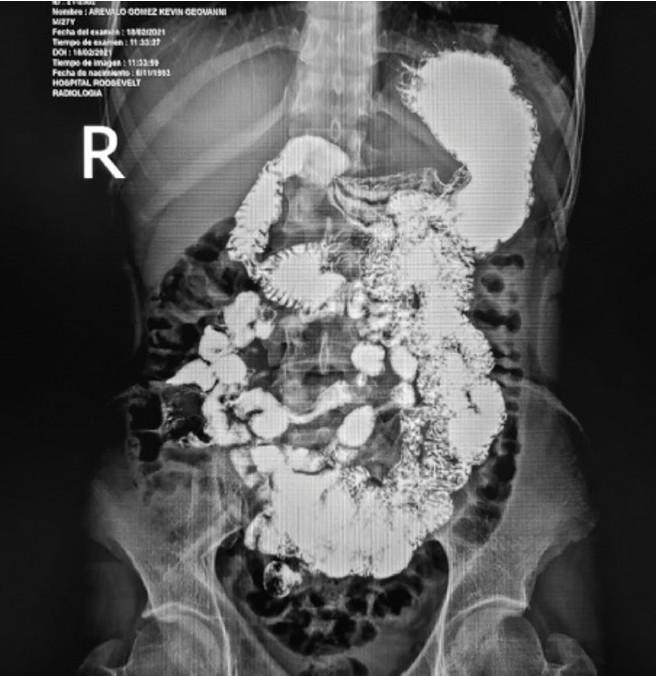 Síndrome de la Arteria Mesentérica Superior: Abordaje Quirúrgico Síndrome de la Arteria Mesentérica Superior: Abordaje Quirúrgico