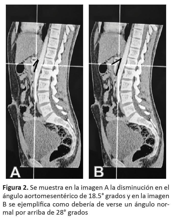 Síndrome de la Arteria Mesentérica Superior: Abordaje Quirúrgico Síndrome de la Arteria Mesentérica Superior: Abordaje Quirúrgico