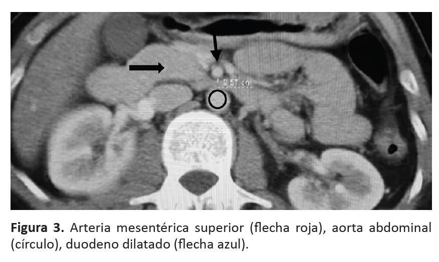 Síndrome de la Arteria Mesentérica Superior: Abordaje Quirúrgico Síndrome de la Arteria Mesentérica Superior: Abordaje Quirúrgico
