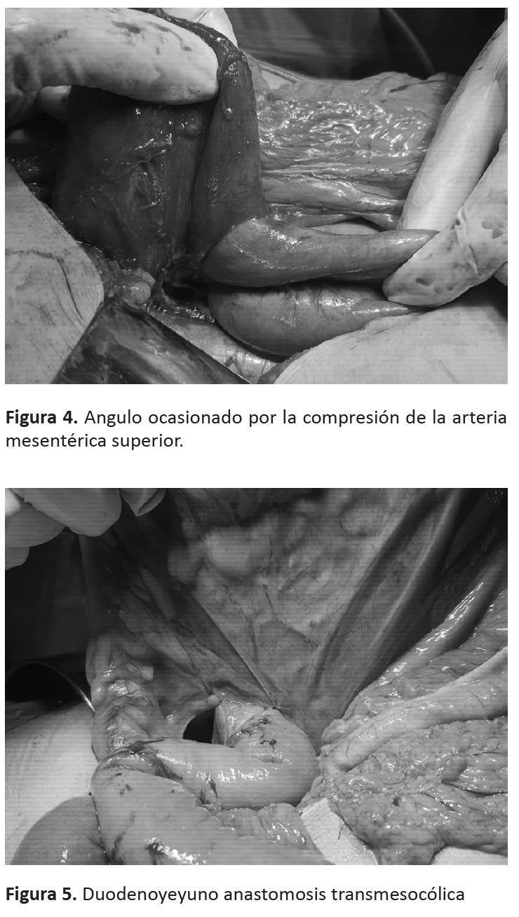Síndrome de la Arteria Mesentérica Superior: Abordaje Quirúrgico