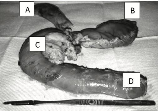 Procedimiento de Whipple: Experiencia de un Centro en Fase de Crecimiento en Cirugía Hepato-Bilio-Pancreática Procedimiento de Whipple: Experiencia de un Centro en Fase de Crecimiento en Cirugía Hepato-Bilio-Pancreática