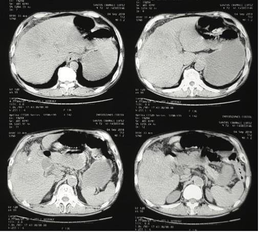 Obstruccion Intestinal por Íleo Biliar: Reporte de un Caso