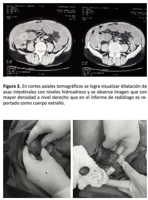 Obstruccion Intestinal por Íleo Biliar: Reporte de un Caso
