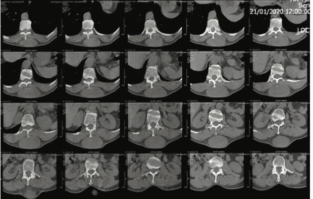Colgajo “Keystone” (Colgajo en Piedra Angular) para Reconstrucción de Defectos Amplios en tórax posterior. Reporte de Caso