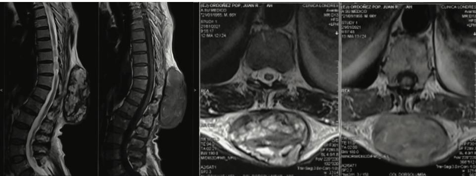 Colgajo “Keystone” (Colgajo en Piedra Angular) para Reconstrucción de Defectos Amplios en tórax posterior. Reporte de Caso Colgajo “Keystone” (Colgajo en Piedra Angular) para Reconstrucción de Defectos Amplios en tórax posterior. Reporte de Caso