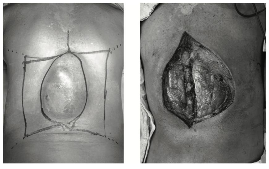 Colgajo “Keystone” (Colgajo en Piedra Angular) para Reconstrucción de Defectos Amplios en tórax posterior. Reporte de Caso