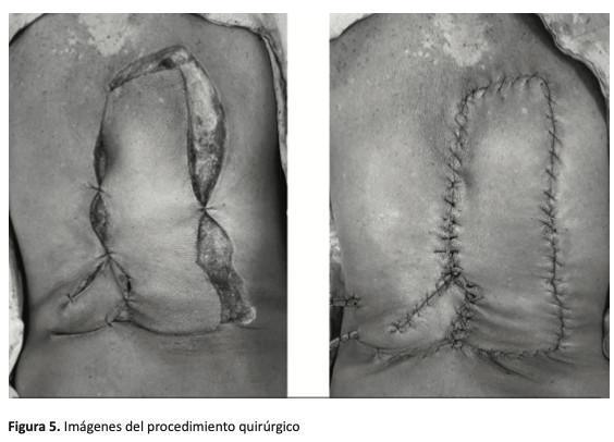 Colgajo “Keystone” (Colgajo en Piedra Angular) para Reconstrucción de Defectos Amplios en tórax posterior. Reporte de Caso
