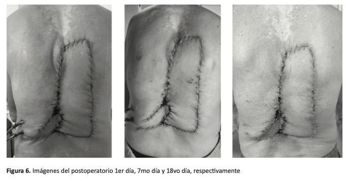 Colgajo “Keystone” (Colgajo en Piedra Angular) para Reconstrucción de Defectos Amplios en tórax posterior. Reporte de Caso