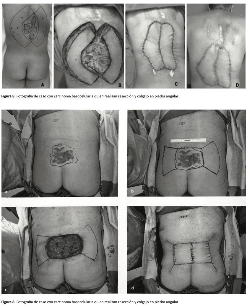 Colgajo “Keystone” (Colgajo en Piedra Angular) para Reconstrucción de Defectos Amplios en tórax posterior. Reporte de Caso