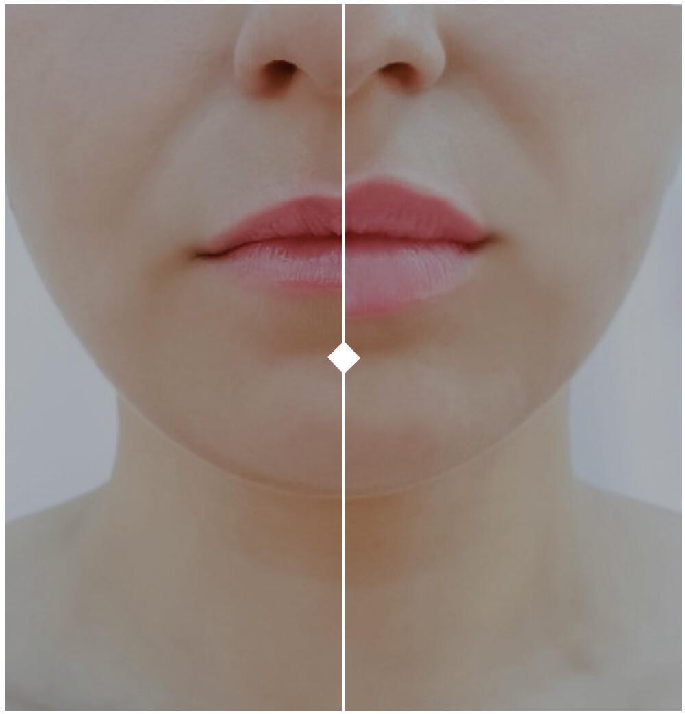 FILLER LABBRA: Sorridi con Sicurezza