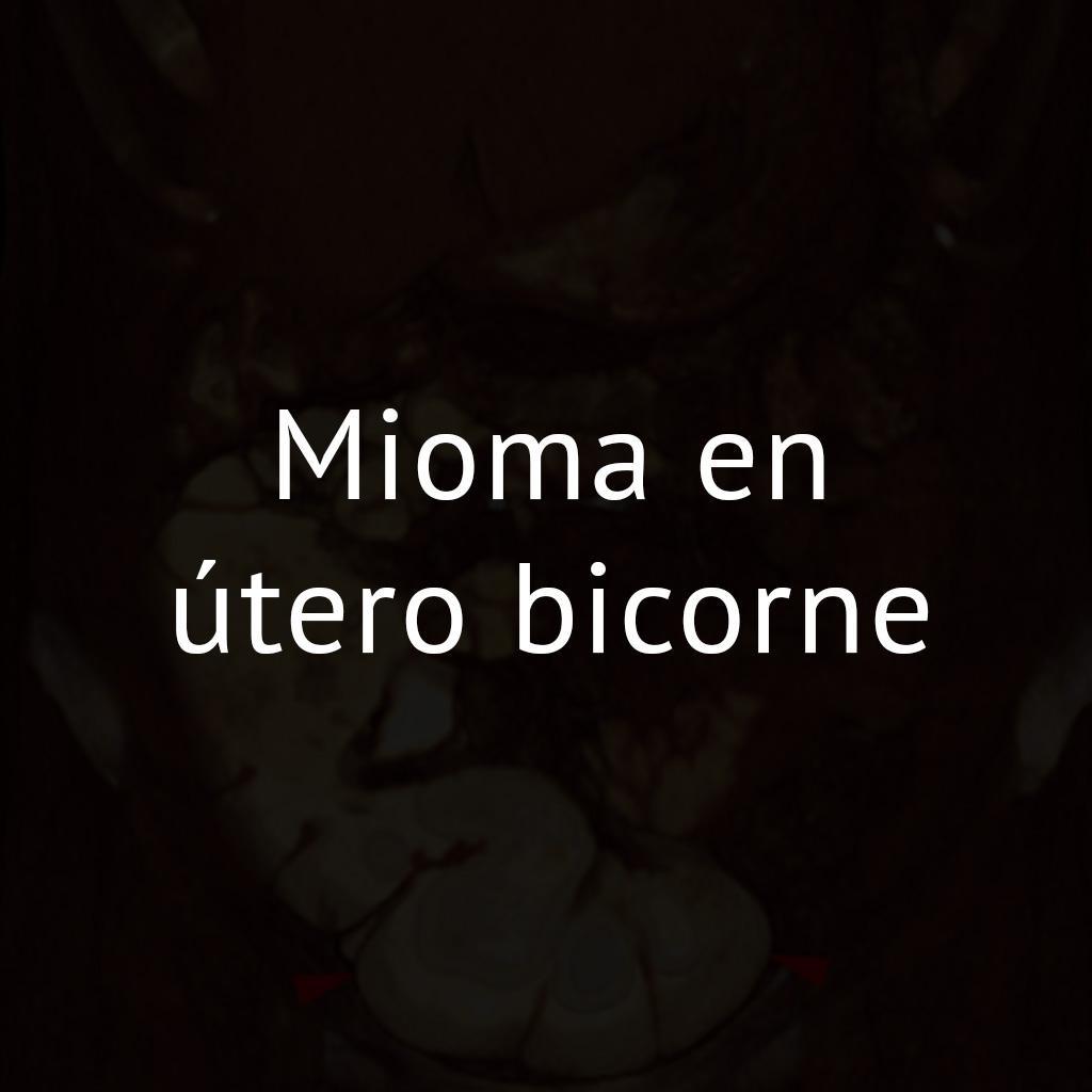 Mioma en útero bicorne
