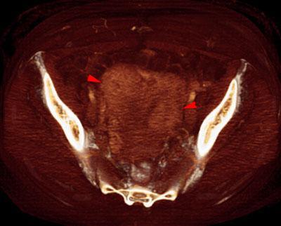 Mioma en útero bicorne