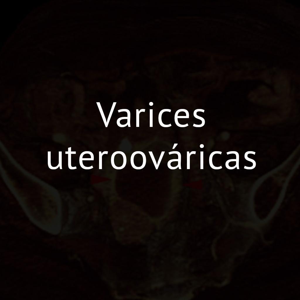 Varices uteroováricas