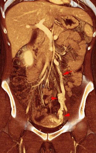 Varices uteroováricas