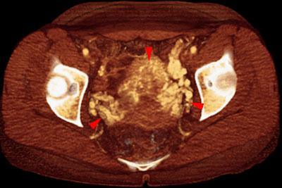 Varices uteroováricas