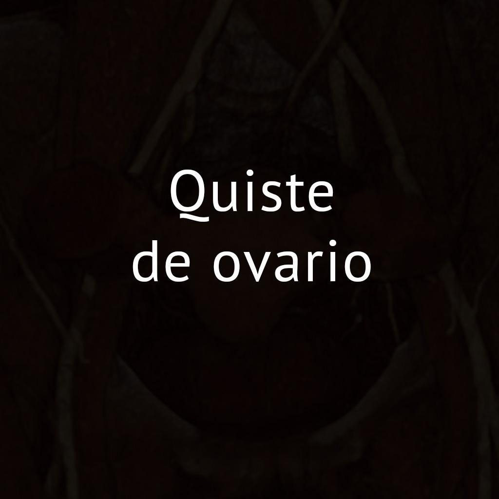 Quiste de ovario