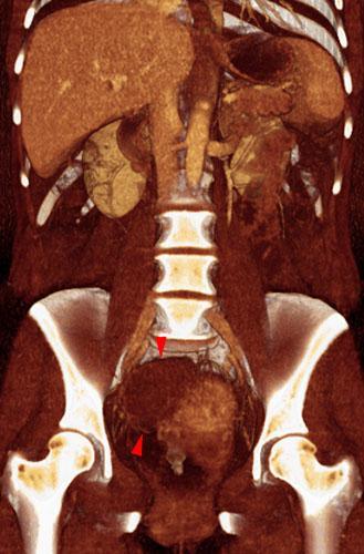 Quiste endometrial