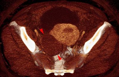 Quiste endometrial