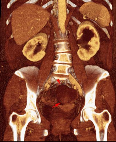 Quiste habitado Carcinoma ovárico