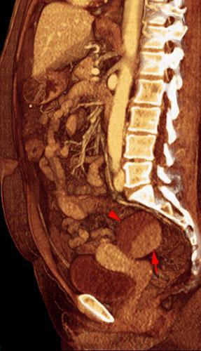 Quiste habitado Carcinoma ovárico
