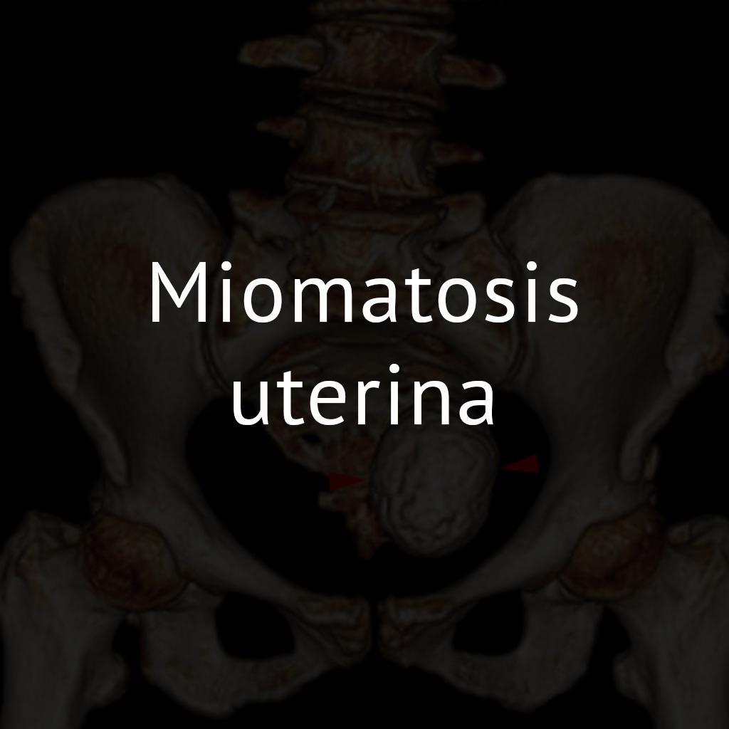 Miomatosis uterina