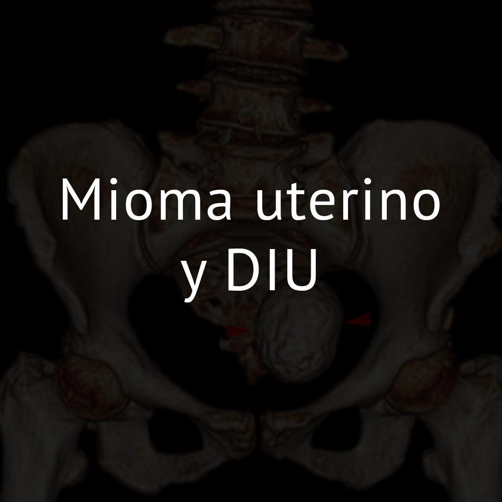 Mioma uterino y DIU