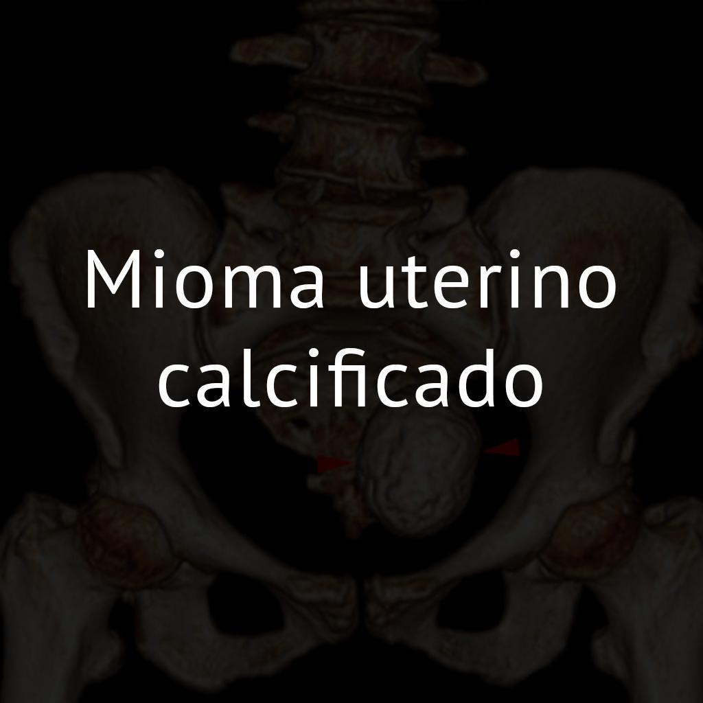 Mioma uterino calcificado
