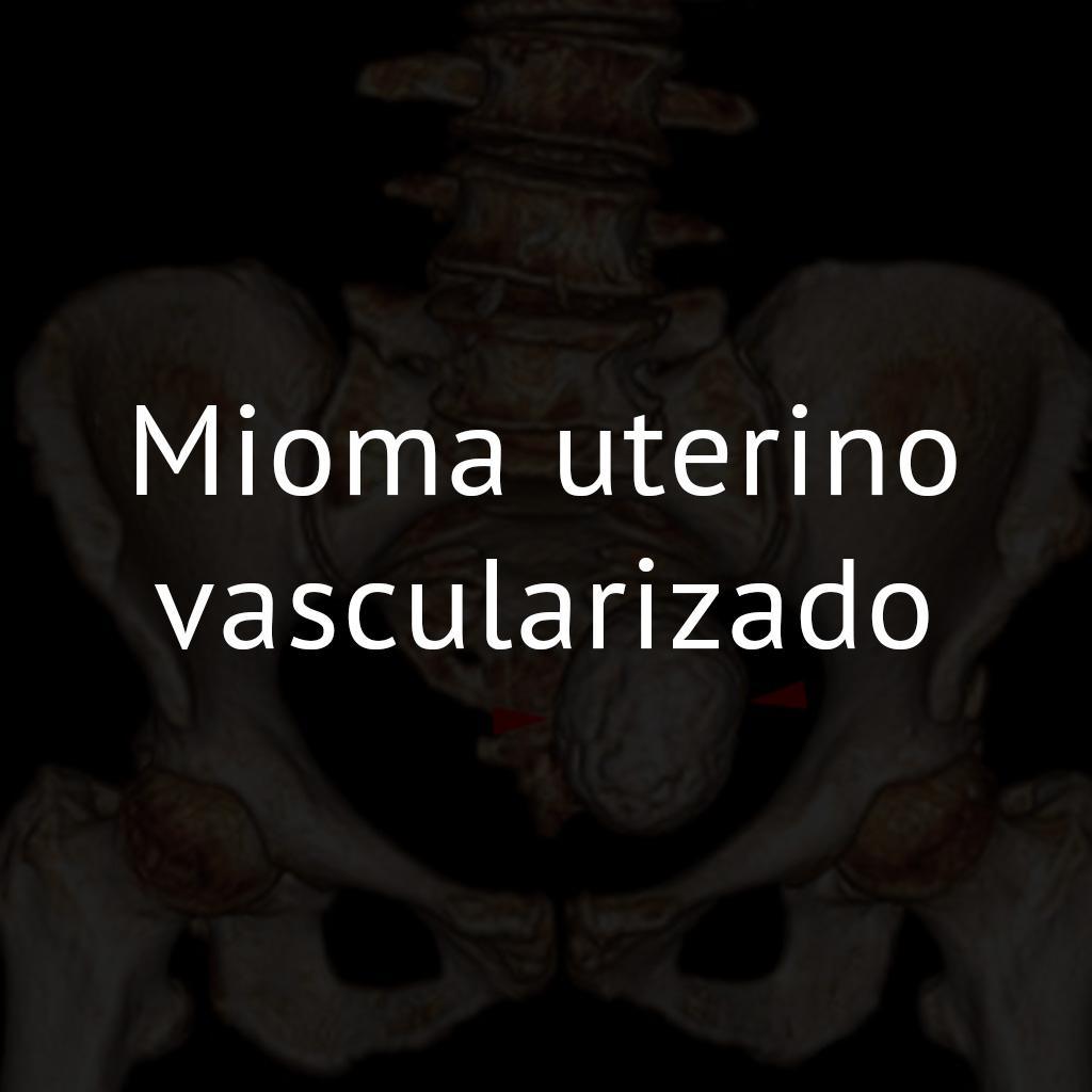 Mioma uterino vascularizado