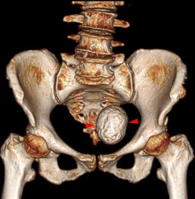 Mioma uterino calcificado