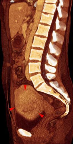 Mioma uterino 